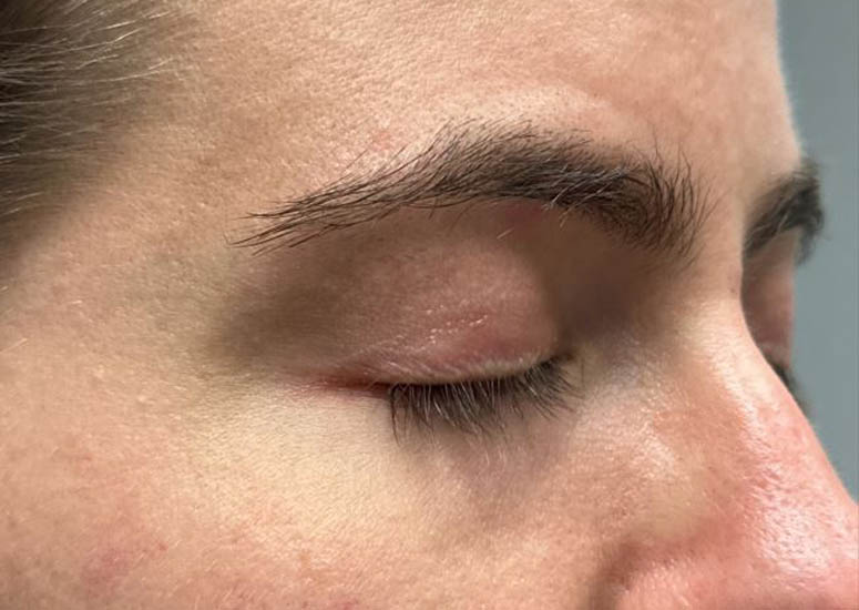 1_0005_patient 9 after CO2 for eyelid scars–side.JPG