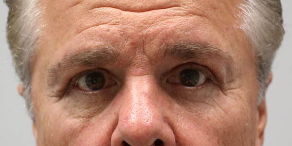 1_0005_patient 9 after quad bleph with facial fat grafting.JPG