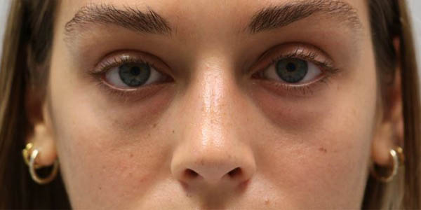 1_0006_patient 56 before lower bleph with facial fat grafting.JPG