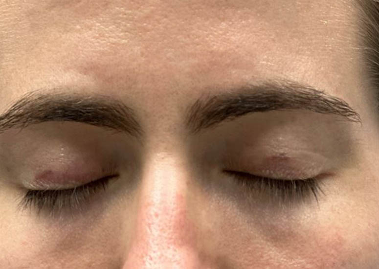 1_0006_patient 9 before CO2 for eyelid scars.JPG