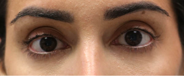 1_0006_patient before subbrow filler – Copy (2).PNG