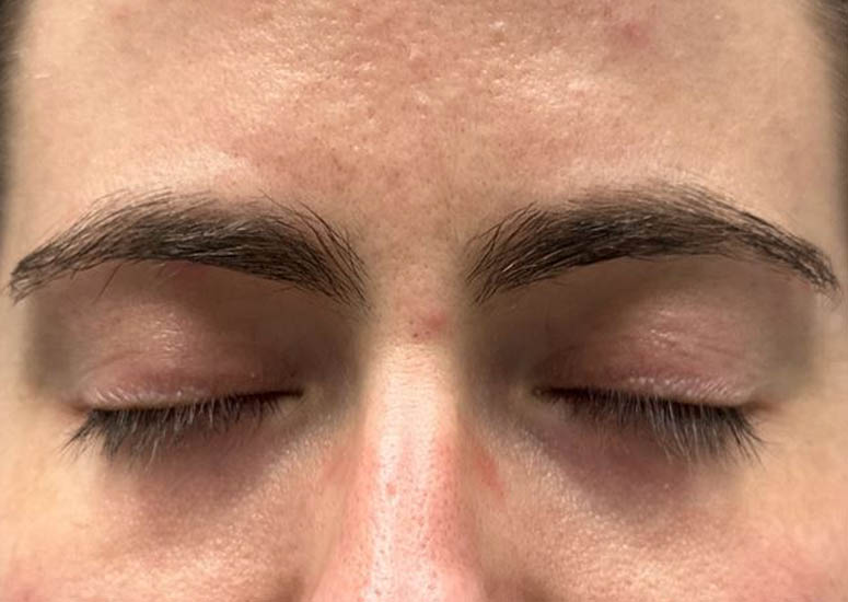 1_0007_patient 9 after CO2 for eyelid scars.JPG