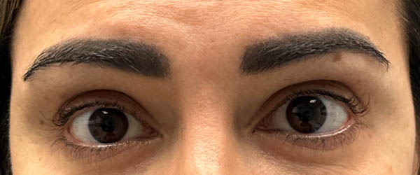 1_0007_patient after subbrow filler.PNG