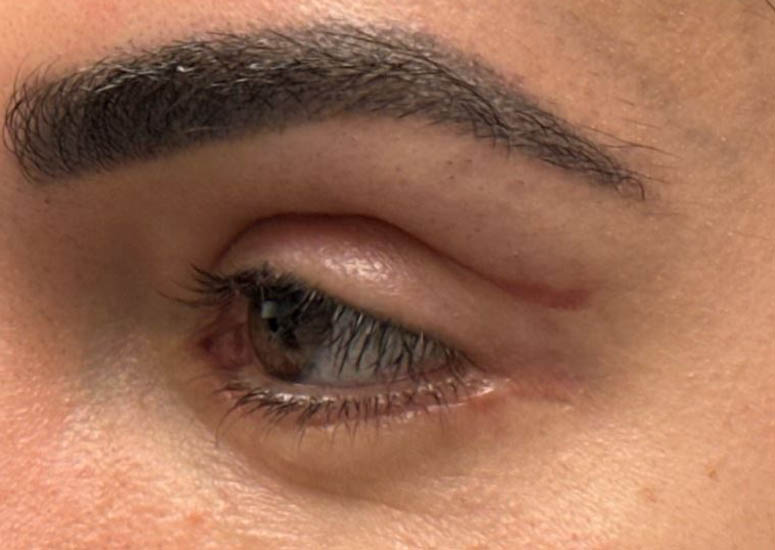 1_0008_patient 5 scar revision– before 1 5FU injection– side.JPG
