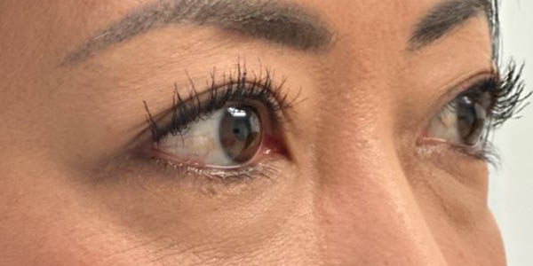 1_0008_patient 57 before lower bleph with facial fat grafting.JPG