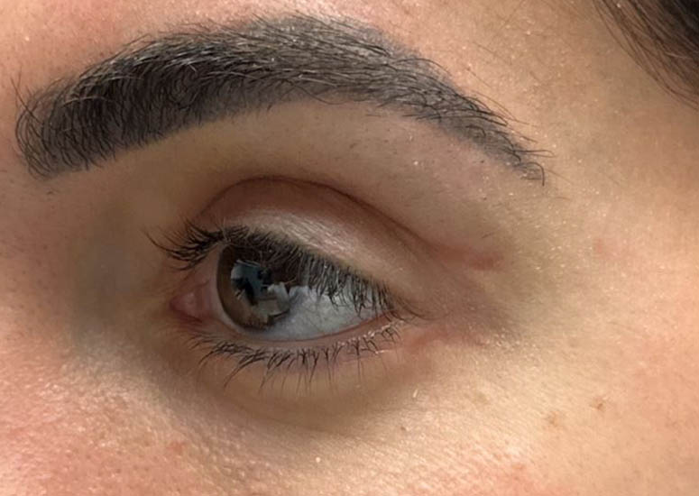 1_0009_patient 5 scar revision– after 1 5FU injection–side.JPG