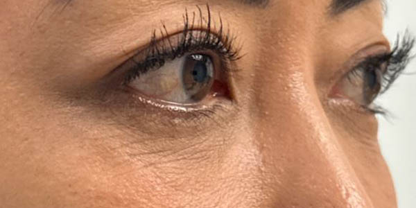 1_0009_patient 57 after lower bleph with facial fat grafting.JPG