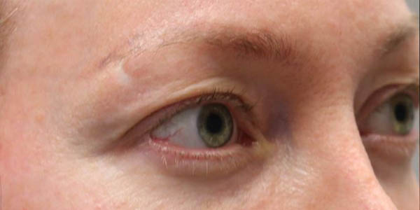 1_0010_patient 100 before upper bleph.JPG