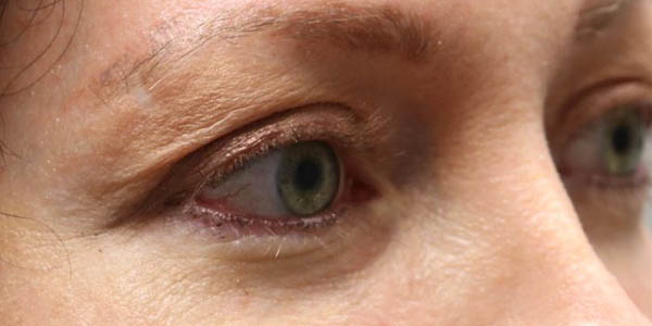 1_0011_patient 100 after upper bleph.JPG