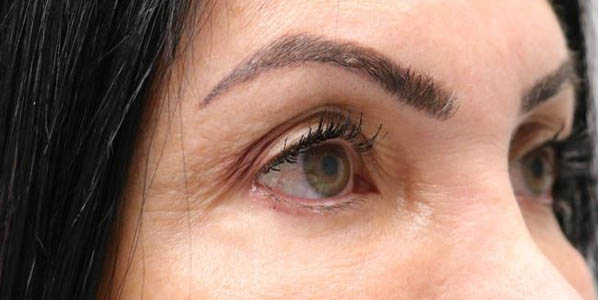 1_0012_patient 102 before upper bleph with subbrow filler.JPG
