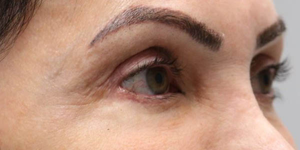 1_0013_patient 102 after upper bleph with subbrow filler.JPG