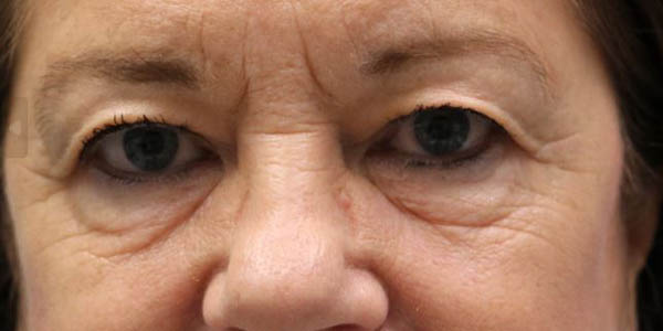 1_0014_patient 104 before upper bleph with internal browpexy.JPG