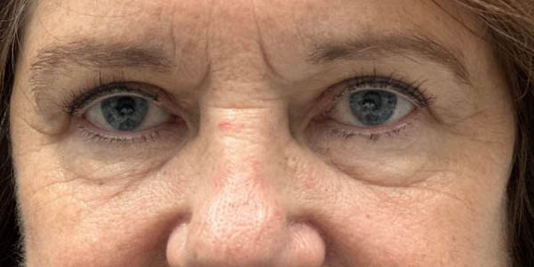 1_0015_patient 104 after upper bleph with internal browpexy.JPG