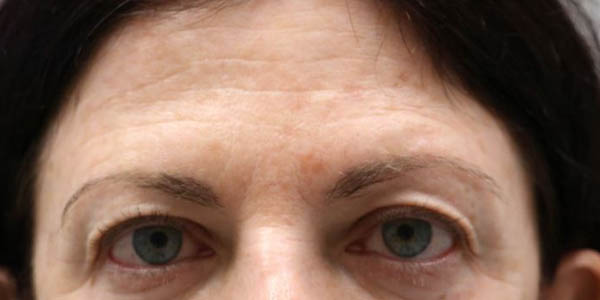 1_0016_patient 1054 before upper bleph with internal browpexy.JPG