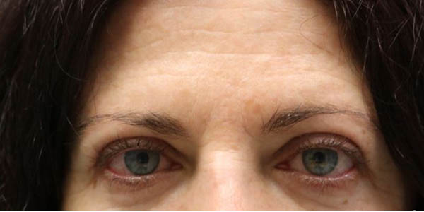 1_0017_patient 1054 after upper bleph with internal browpexy.JPG