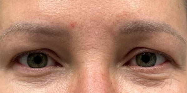 1_0018_patient 101 before upper bleph with subbrow filler.JPG