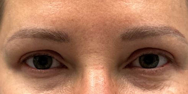 1_0019_patient 101 after upper bleph with subbrow filler.JPG