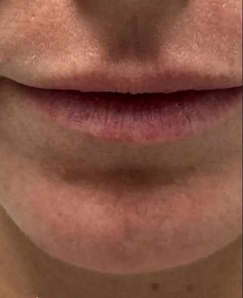 patient 7 after CO2 for chin scar