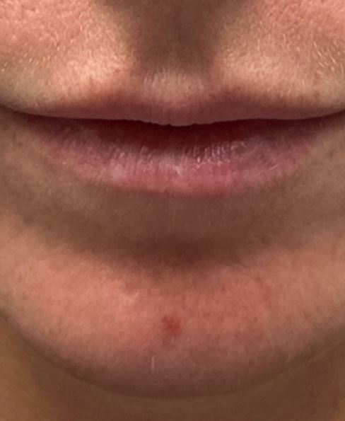 patient 7 before CO2 for chin scar