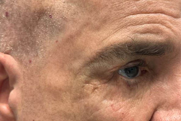 xx_0001_patint 10 lid retraction repair with full thickness skin graft before.JPG