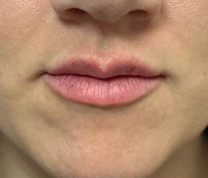 1_0000_patient 10 after lip filler.JPG