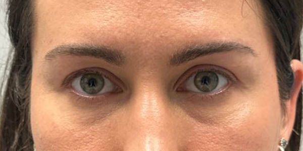 1_0000_patient 200 before upper bleph with subbrow filler–front.JPG