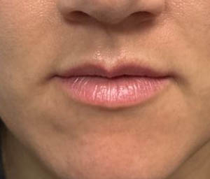 1_0001_patient 10 before lip filler.JPG
