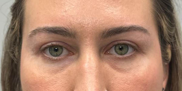 1_0001_patient 200 after upper bleph with subbrow filler–front.JPG