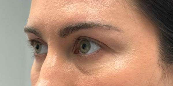 1_0002_patient 200 before upper bleph with subbrow filler–left side.JPG
