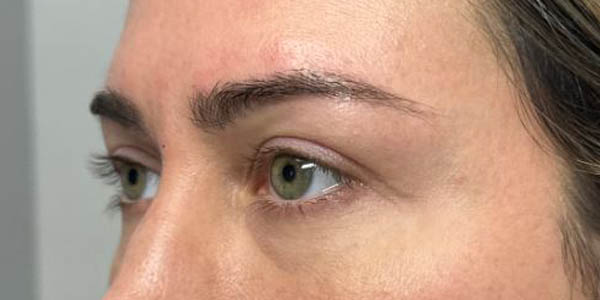 1_0003_patient 200 after upper bleph with subbrow filler–left side.JPG