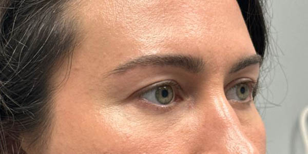 1_0004_patient 200 before upper bleph with subbrow filler–right side.JPG
