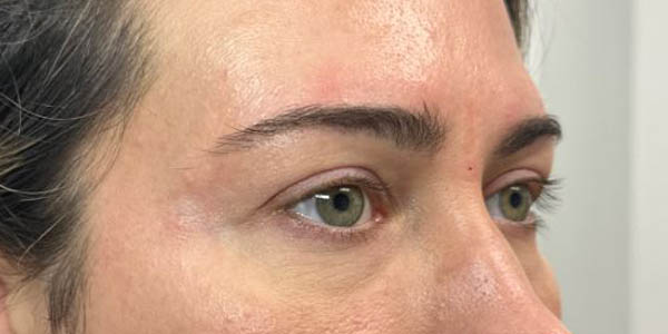 1_0005_patient 200 after upper bleph with subbrow filler–right side.JPG