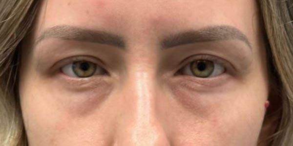 1_0000_pt 555 before lower bleph with fat grafting and CO2.JPG