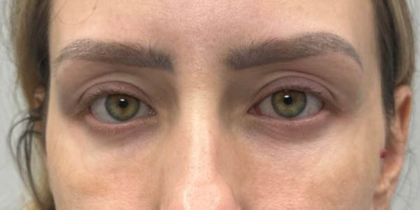 1_0001_pt 555 after lower bleph with fat grafting and CO2.JPG