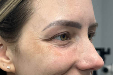 1_0002_patient 8 before botox– side.JPG
