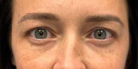 1_0000_patient 77 before upper bleph with subbrow filler (1 month post op).JPG