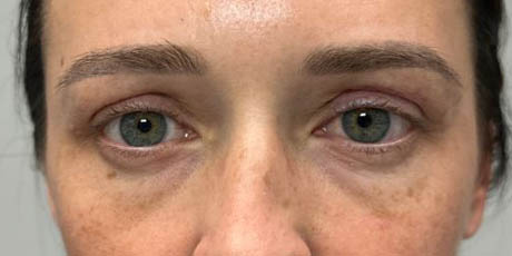 1_0001_patient 77 after upper bleph with subbrow filler (1 month post op).JPG