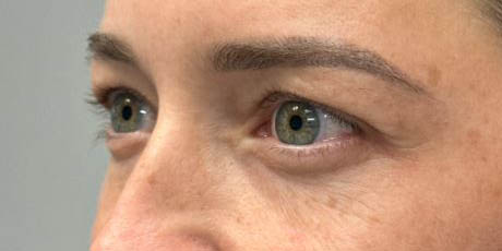 1_0002_patient 77 before upper bleph with subbrow filler (1 month post op)–side.JPG