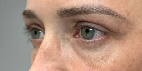 1_0003_patient 77 after upper bleph with subbrow filler (1 month post op)–side.JPG
