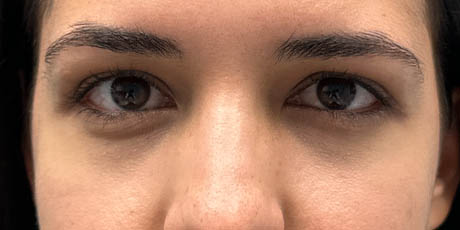 1_0001_Patient 1 after Lower Bleph with micro Fat Grafting to lower lids and mid-face.jpg