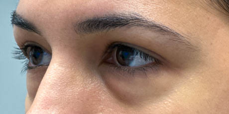1_0002_Patient 1 before side Lower Bleph with micro Fat Grafting to lower lids and mid-face.jpg