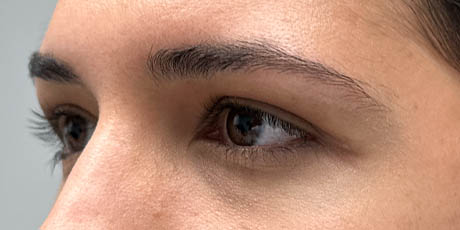 1_0003_Patient 1 after side Lower Bleph with micro Fat Grafting to lower lids and mid-face.jpg
