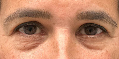 1_0004_patient 2 before lower bleph with facial fat grafting to lower lids and mid-face (front).PNG