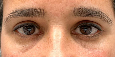 1_0005_patient 2 after lower bleph with facial fat grafting to lower lids and mid-face(front).PNG