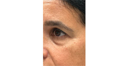1_0006_patient 2 before lower bleph with facial fat grafting to lower lids and mid-face (side).PNG