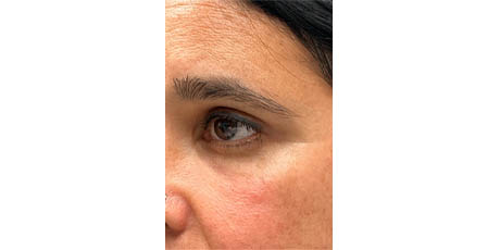 1_0007_patient 2 after lower bleph with facial fat grafting to lower lids and mid-face (side).PNG