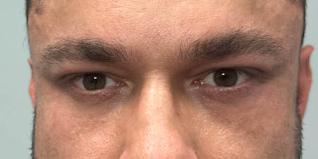 1_0007_pt 2 after peri-orbital ultraclear.png