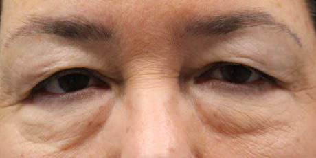 1_0008_Pt 1 before asian bleph – front.JPG
