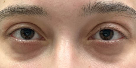 1_0008_patient 3 before lower bleph with facial fat grafting to lower lids and mid-face (front).PNG