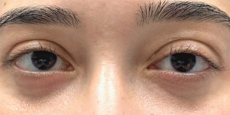 1_0009_patient 3 after lower bleph with facial fat grafting to lower lids and mid-face(front).PNG